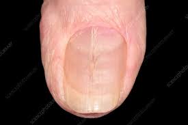 ridged finger nail in eczema stock