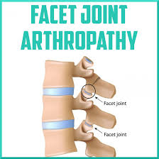 facet joint arthropathy sports