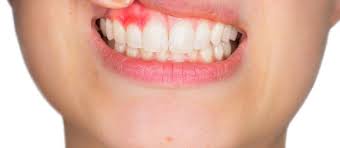 home remes for tooth gum abscess