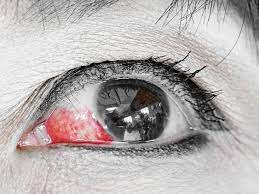 eye bleeding types causes treatment