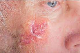 Some types of skin cancer are more dangerous than others, but if you have a spot. Will Skin Cancer Surgery Leave Unsightly Scars Naperville Skin Cancer Surgery John Bull Center For Cosmetic Surgery Laser Medispa
