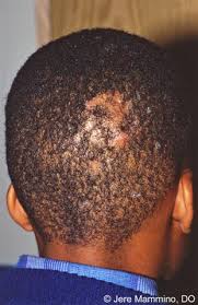 Hair loss due to this cause cannot be treated effectively until the psychological or emotional problems are addressed first. Hair Loss American Osteopathic College Of Dermatology Aocd