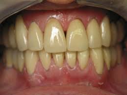 The internet is loaded with a lot of information on natural teeth whitening tips that can help reduce coffee stains. Pin On Herbal Remedies
