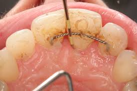 abscessed teeth perio peak