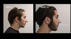 Use a soap meant for your face or simply use plain water. Minoxidil Beard Growth 3 Month Transformation Timelapse Before And After Youtube