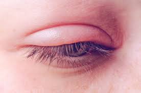 blepharitis san jose spectrum eye