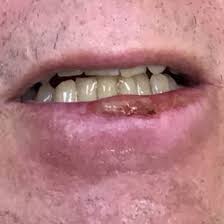 how skin cancer appears on lips