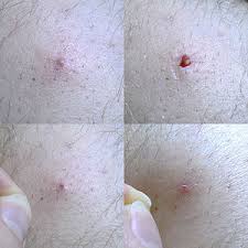 Sometimes, a cyst can develop. Ingrown Hair Wikipedia