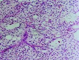 myxoid liposarcoma showing lipoblasts