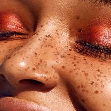 causes freckles allure