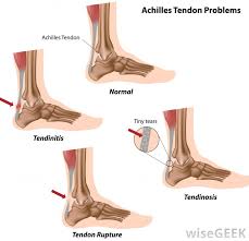 The conjoint tendon, also known as henle's ligament, forms when the medial fibers of the internal oblique aponeurosis unite with the deeper fibers of the transversus abdominis aponeurosis. What Is The Difference Between A Ligament And A Tendon