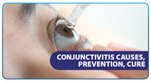 conjunctivitis causes prevention