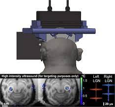 Remus System For Remote Deep Brain