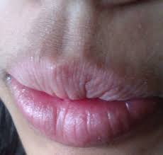 lip eczema