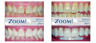 Toronto Dentist | Zoom Teeth Whitening | Sheppard Jane Dental Clinic