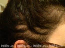 On the other end, hyperthyroidism, an overactive thyroid, may cause anything from weight loss to nervousness. I Stopped Taking Synthroid 2 5 Years Ago And I M Still Having Female Hair Loss Wrassman M D Baldingblog