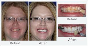 Can you whiten your teeth with braces and how to whiten your teeth with braces? Teeth Whitening Dental Excellence