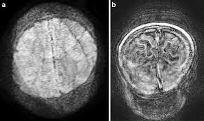 unexpected mri artifacts experience