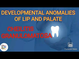 developmental anomalies of lip palate