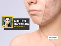 acne scars hiding your face due to