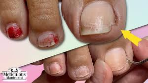 tools for ingrown toenails how to