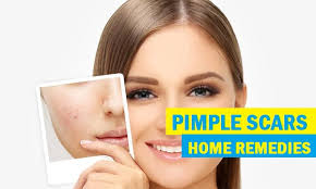 home remes for pimple scars removal