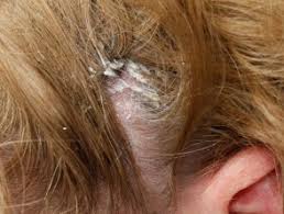 • hair loss (alopecia) • thinning hair • brittle nails • skin rash • loss of hair color • mild depression • muscle pain • extreme tiredness it's important to know what could be causing a biotin deficiency. Diagnosis Of Scalp Rashes Dermnet Nz