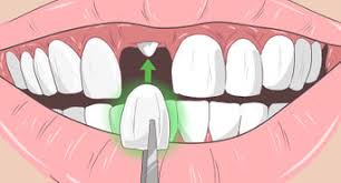 Jun 26, 2020 · 1. 3 Ways To Fix Nicotine Stained Teeth Wikihow