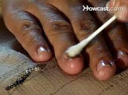 how to cure nail fungus you