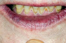 purple lips due to cyanosis stock