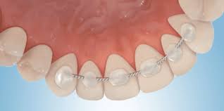 For fixed retainers — if you are wearing a fixed retainer, the only thing that you need to take care of is making sure that you floss between the wire which is attached to your teeth so that they remain protected from teeth cavities and gum infections. Permanent Retainers What You Need To Know Jonathan Shouhed Dds Orthodontist