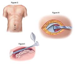 about laparoscopic hernia surgery