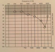How To Read An Audiogram Iowa Head And Neck Protocols