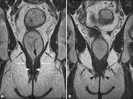 dynamic pelvic floor imaging mri