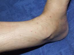 Abnormal skin texture, redness, red small lumps over the skin and irritation are all symptoms of skin rashes. Flea Bites On Humans Symptoms And Treatment Dengarden