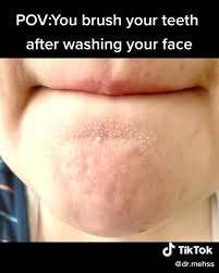 tooth brushing routine causes acne