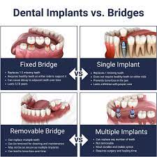 dental implants vs bridges finding