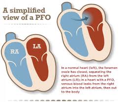 If the hole is large, too much blood will be pumped to the lungs. Patent Foramen Ovale Pfo American Heart Association
