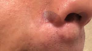 lip sebaceous cyst removal dr carlos