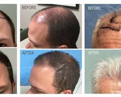 صورة FUE hair transplant natural results