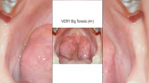 tonsillectomy and or adenoidectomy t a