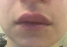 uneven swelling of upper lip