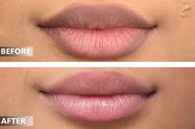 lip laser