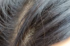 Intense itching on the scalp, body or in the. Pictures Of Head Lice On Hair