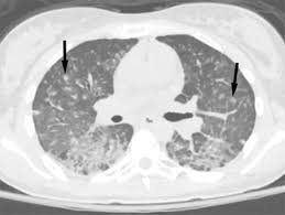 Review Of The Chest Ct Diffeial