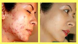acne scars overnight naturally