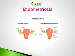 It may attach to the ovaries, fallopian tubes, the exterior of the uterus, the. Ppt Endometriosis Overview Sign Symptoms Causes Diagnosis And Treatment Powerpoint Presentation Id 7633649