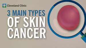 3 types of skin cancer you