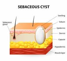 what are sebaceous cysts