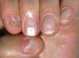 nail patella syndrome uptodate